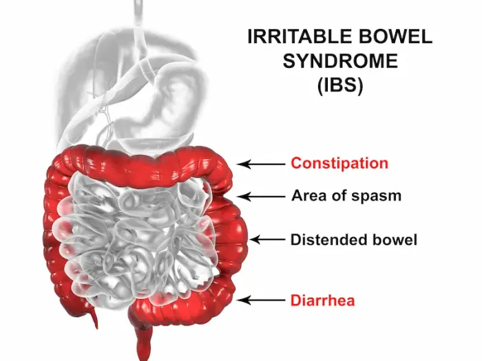 Guide to Irritable Bowel Syndrome Management